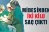 15 yaşındaki çocuğun midesinden 2 kilo saç çıktı