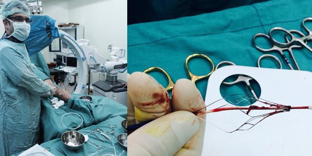 Toplar damar tıkanıklığına 10 dakikada ameliyatsız çözüm