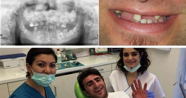 İnanılmaz vaka! Göz çukurunda bile diş vardı