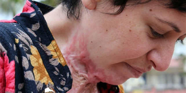 Uyuşturucuya tepki için kendini yaktı!