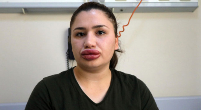 Silikon mağduru hemşirenin son hali