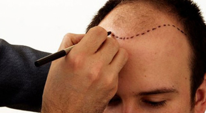 Saç ektirirken dikkat!