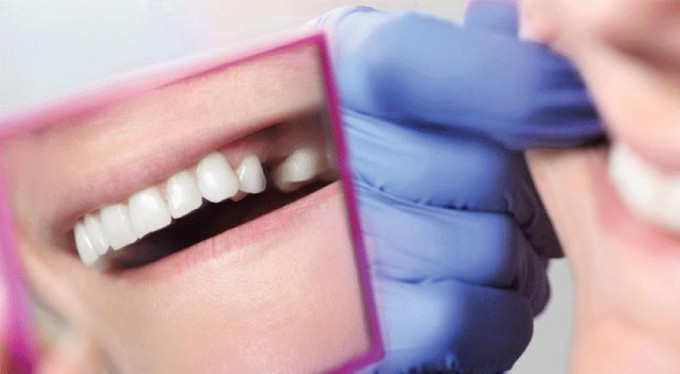 Diş çekmek yerine kanal tedavisi