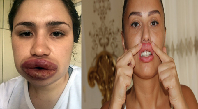 Sahte estetikçi bakın hangi maddeyi kullanmış