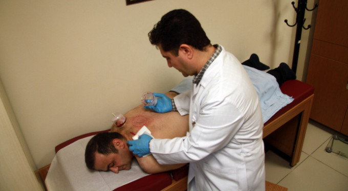 Devlet hastanesindeki ruhsatlı hacamata büyük ilgi