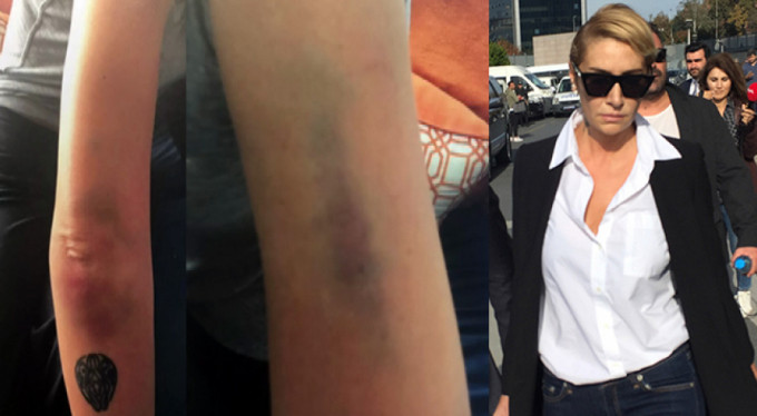 Sıla'nın darp sonucu vücudunda oluşan morlukların fotoğrafları ortaya çıktı