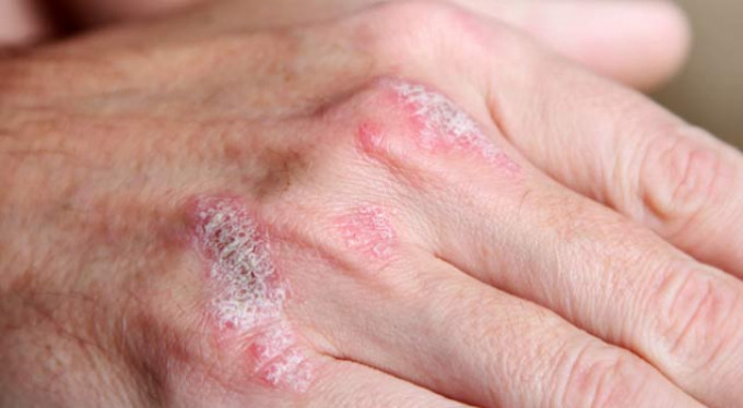 Türkiye'de 2 milyon kişi sedef hastası!