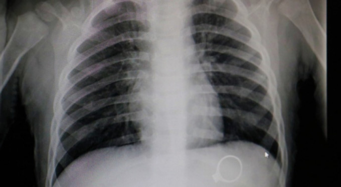 3 bin liralık tek taş yüzüğü yuttu!