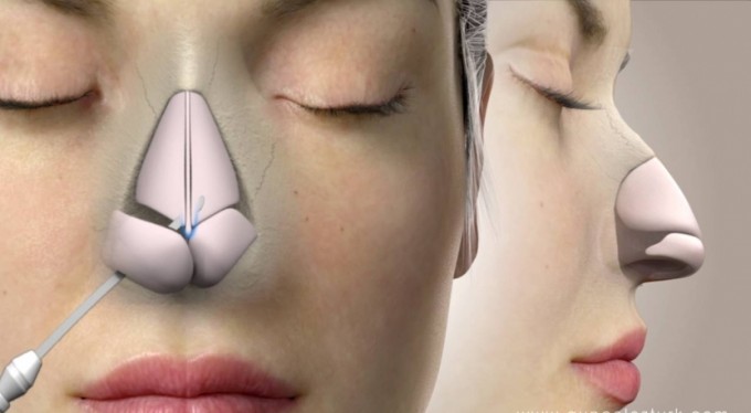 Burun ameliyatlarında estetik kadar nefes almak da önemli