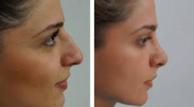 Burun ameliyatı sonrası dikkat edilmesi gerekenler