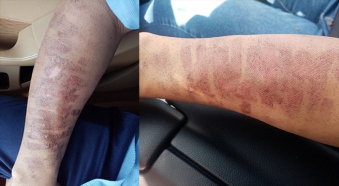 Lazer epilasyon yaptırdı, kolları yandı