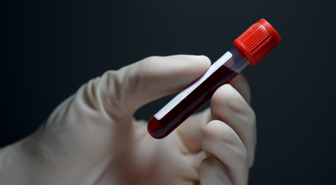 Kırmızı Kan Hücrelerinin Aşırı Miktarda Üretilmesi: Polisitemi