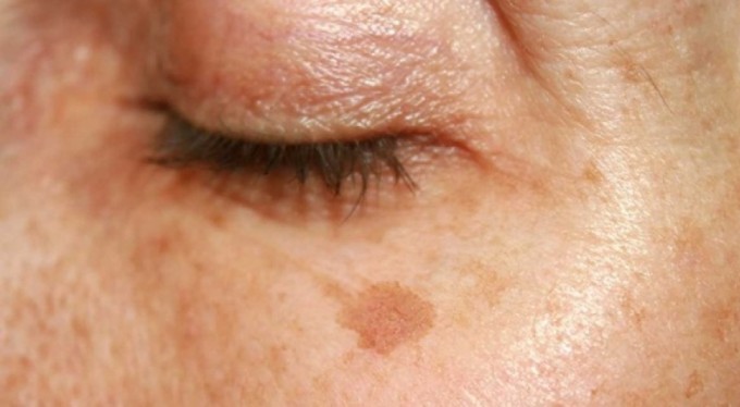 Güneş lekelerinden kurtulmanın yolları