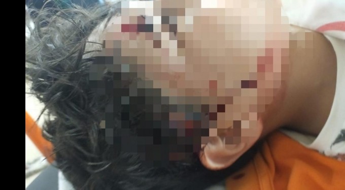 Okula giden 10 yaşındaki çocuğa başıboş 8 köpek saldırdı, 80 dikiş atıldı