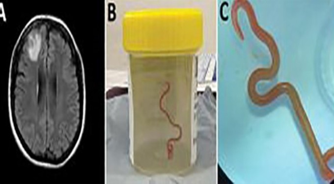 Dünyada ilk: Avustralya'da bir hastanın beyninden canlı solucan çıkarıldı