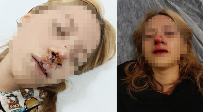 Genç kızın yüzüne kaldırım taşı atıp, dişlerini kırdılar