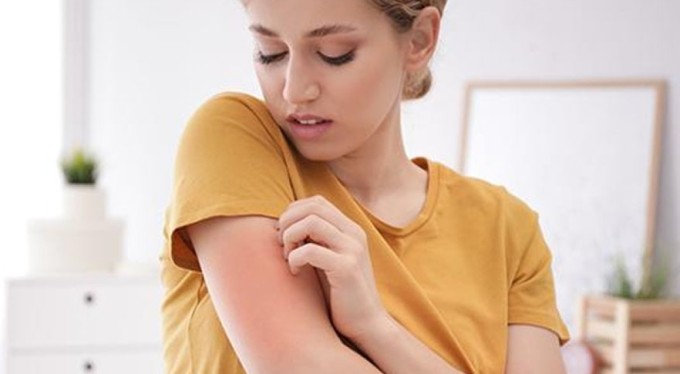 Uyuzda korkutan açıklama: "2-3 aydır vakalarda artış var, sık sık görmeye başladık"