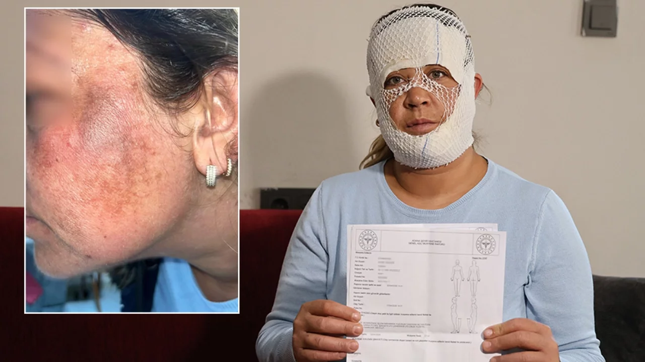 "Cilt Bakımı" Sonrası Kabus: Kadının Yüzü Yandı, 2 Yaşındaki Oğlu Korkudan Düştü