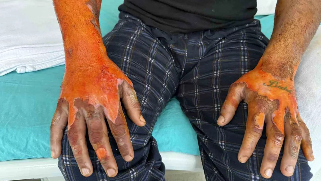 Akü patladı: Şoförün vücudunun yüzde 25'i yandı